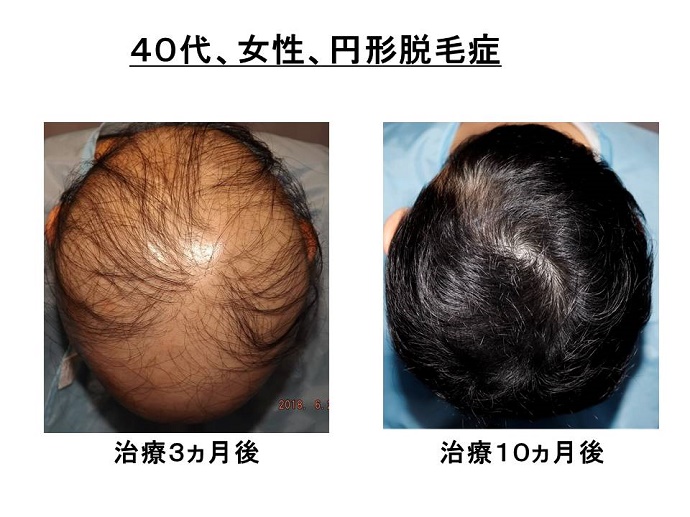 円形脱毛症　病院